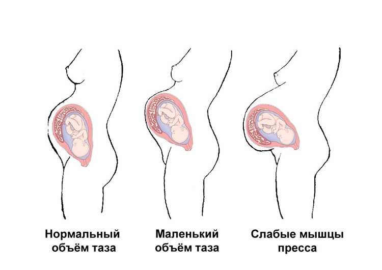 Поддержка живота: использование подушек