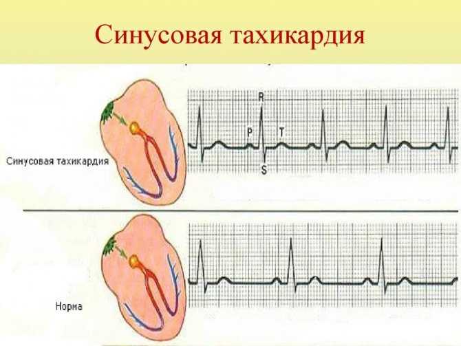Рекомендации по физической активности при повышенной частоте сердечных сокращений