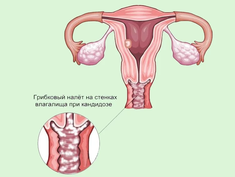Молочница при беременности — симптомы, лечение и советы на форуме для будущих мам в 1 триместре